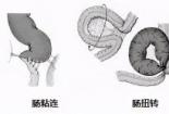 粘连性肠梗阻，了解症状、治疗方法与手术适应症