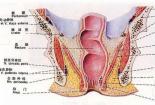肛门息肉的症状及处理方法，及时发现与治疗的重要性