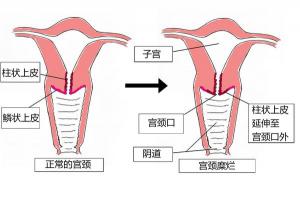 宫颈糜烂的治疗方案：药物治疗、物理治疗与手术治疗的选择