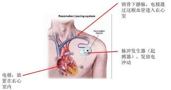 心脏起搏器的好搭档：程控器，轻松调控心跳频率