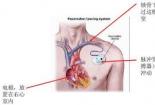 心脏起搏器的好搭档：程控器，轻松调控心跳频率