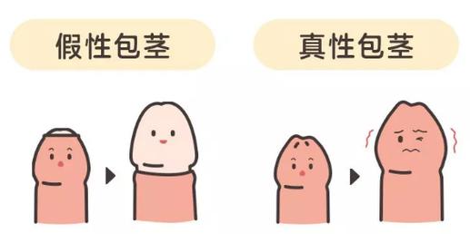 包皮过长危害大揭秘：影响发育、性功能与阴茎健康