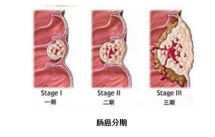 直肠癌症状：早期识别，预防恶化