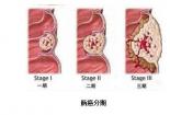 直肠癌症状：早期识别，预防恶化