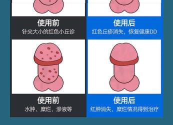 包皮痒：原因、治疗与预防措施