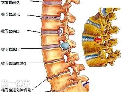 椎管狭窄：病因、症状与防治方法