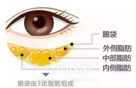 眼袋的形成：年龄与睡眠不足的双重影响