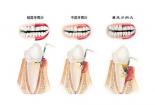 单纯性牙周炎：早期识别与治疗的重要性