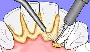 为什么会有牙结石：原因与预防措施