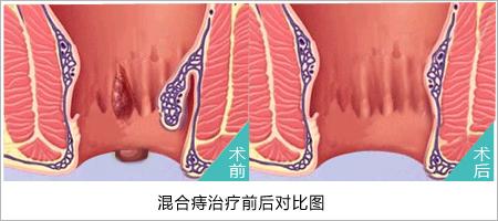 外痔的症状：疼痛、异物感与脱出，了解与应对之道