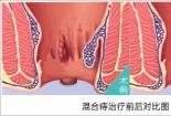 外痔的症状：疼痛、异物感与脱出，了解与应对之道