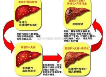 肝硬化肝功能正常？揭秘肝硬化与肝功能的关系，早发现早治疗！