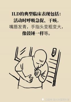 干咳是什么症状？一文带你了解干咳的特点与成因