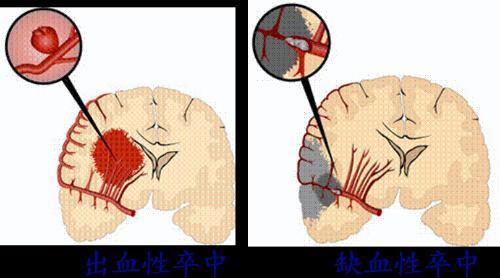 脑出血后遗症全解析：了解常见症状，科学应对风险