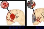 脑出血后遗症全解析：了解常见症状，科学应对风险