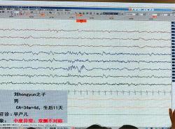 大脑异常放电：原因、预防与治疗方法全面解析