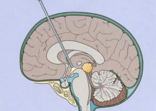 了解脑积水：原因、症状与治疗方法