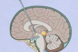 了解脑积水：原因、症状与治疗方法