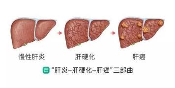 硬化肝能治疗吗？了解肝硬化治疗的关键与时机