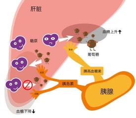 糖尿病前期：早期控制，守护健康