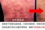 荨麻疹能治好吗？：荨麻疹并非不治之症，治愈方法及注意事项