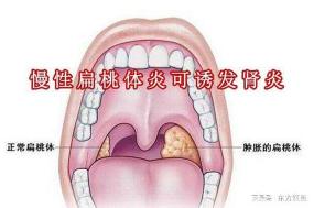 慢性扁桃炎全解析：症状识别、治疗方法与日常调理指南