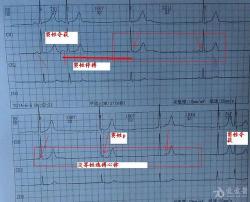 心电图特征：窦性心动过缓的秘密