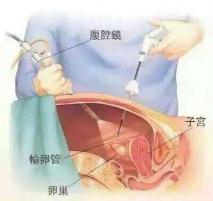 输卵管复通术：解决怀孕难题的有效方法