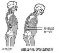 强制性脊椎炎：全方位治疗与日常护理指南