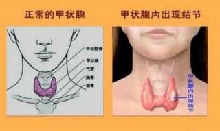 甲状腺肿瘤的治疗与护理：手术治疗、内分泌治疗与核素治疗