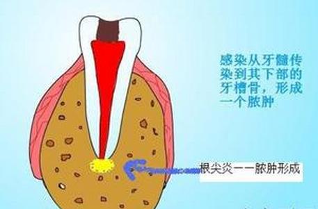 下颚疼：可能是牙周炎或根尖周炎，治疗方法及日常护理