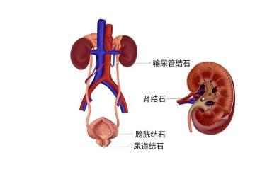 肾结石治疗：中医疗法、西医疗法及外科疗法全面解析